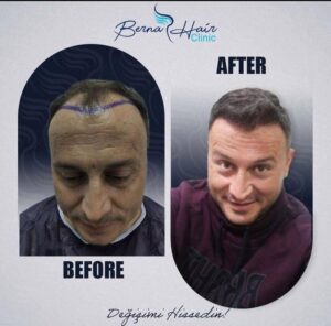 Berna Hair Clinic - Ekim Sonuçları - Saç Ekim Sonuçları