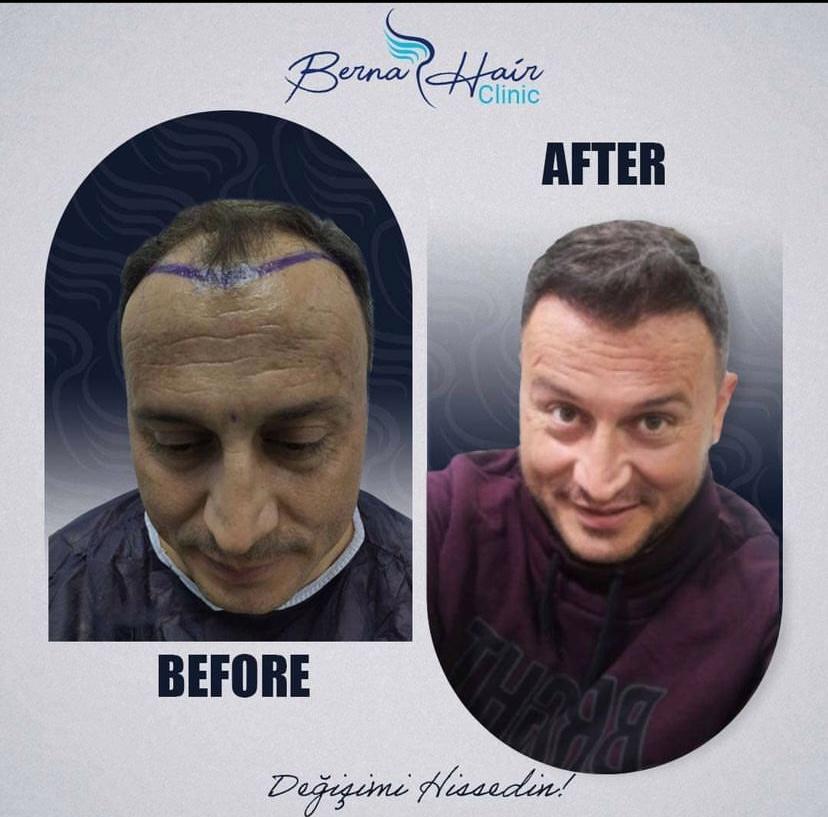 Berna Hair Clinic - Ekim Sonuçları - Saç Ekim Sonuçları