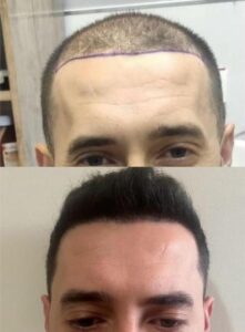 Berna Hair Clinic - Ekim Sonuçları - Saç Ekim Sonuçları