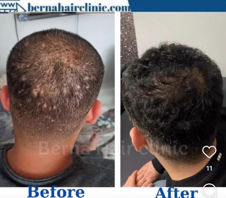 Berna Hair Clinic - Ekim Sonuçları - Saç Ekim Sonuçları